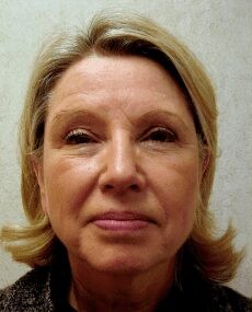 Facelift before and after - before