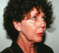 Facelift before and after - before