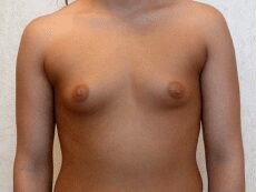 Breast Procedures before and after - before