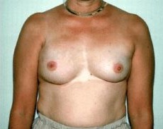 Breast Procedures before and after - after