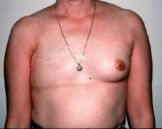 Breast Procedures before and after - before
