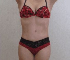 Tummy Tuck & Liposuction before and after - after