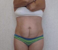 Tummy Tuck & Liposuction before and after - before