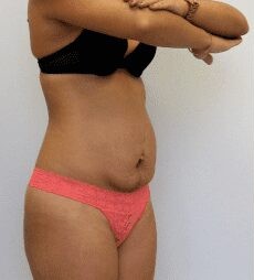 Tummy Tuck & Liposuction before and after - before