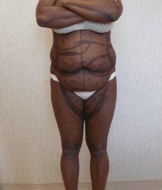 Tummy Tuck & Liposuction before and after - before