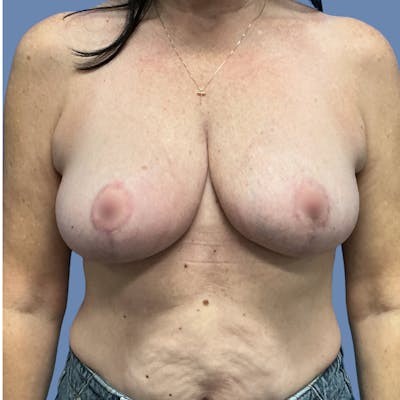 Breast Lift before and after - after