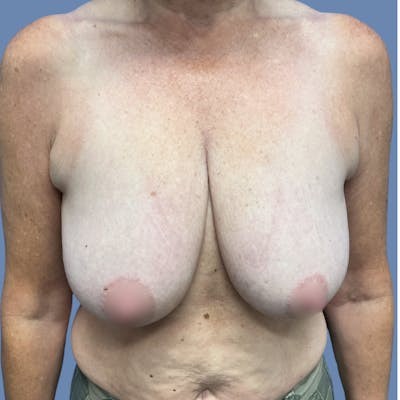 Breast Lift before and after - before