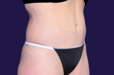 Tummy Tuck (Abdominoplasty) before and after - after