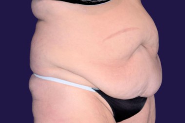 Tummy Tuck (Abdominoplasty) before and after - before