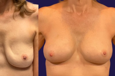 Breast Augmentation (Natural: Fat Transfer) before and after - after