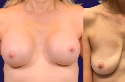 Breast Augmentation (Natural: Fat Transfer) before and after - before