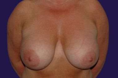 Breast Implant Removal (Explant) before and after - before