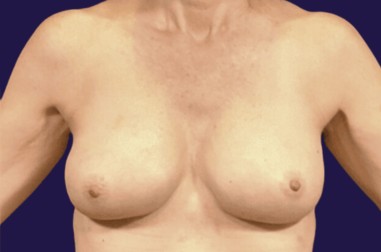 Breast Implant Removal (Explant) before and after - after