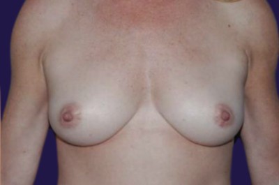 Breast Augmentation (Natural: Fat Transfer) before and after - after