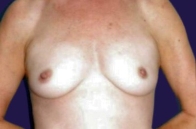 Breast Augmentation (Natural: Fat Transfer) before and after - before