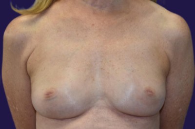 Breast Augmentation (Natural: Fat Transfer) before and after - after