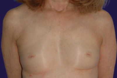 Breast Augmentation (Natural: Fat Transfer) before and after - before