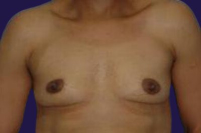 Breast Augmentation (Natural: Fat Transfer) before and after - before