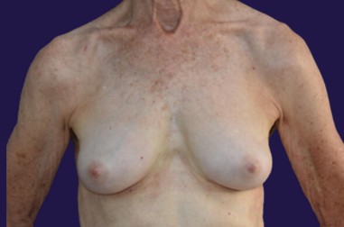 Breast Augmentation (Natural: Fat Transfer) before and after - after