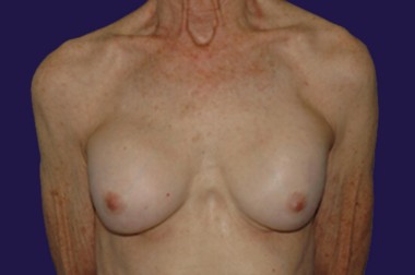 Breast Augmentation (Natural: Fat Transfer) before and after - before