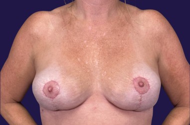 Breast Implant Removal (Explant) before and after - after