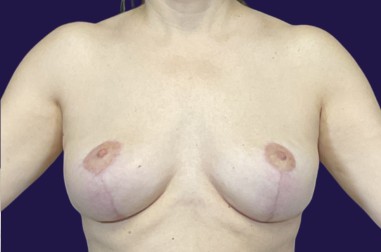 Breast Implant Removal (Explant) before and after - after