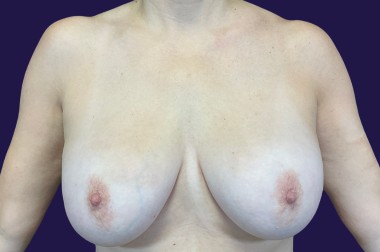 Breast Implant Removal (Explant) before and after - before