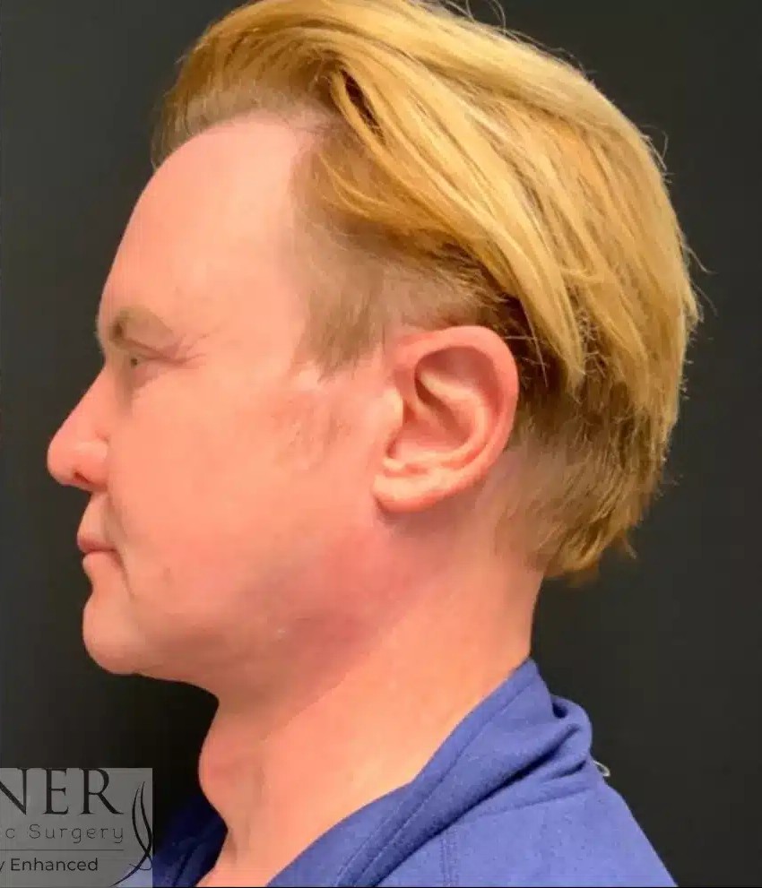 Facial Plastic Surgery for Men before and after - after