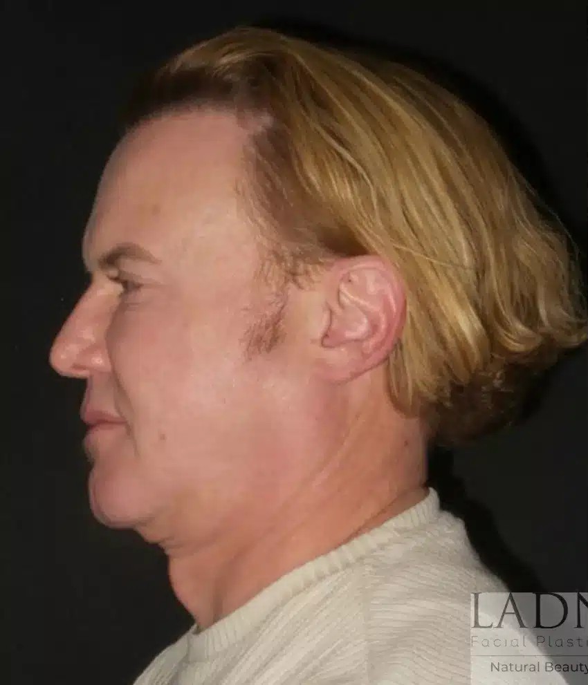 Facial Plastic Surgery for Men before and after - before