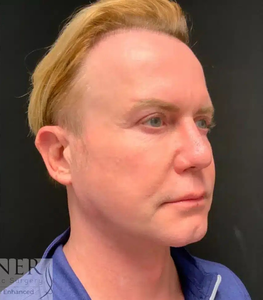 Facial Plastic Surgery for Men before and after - after