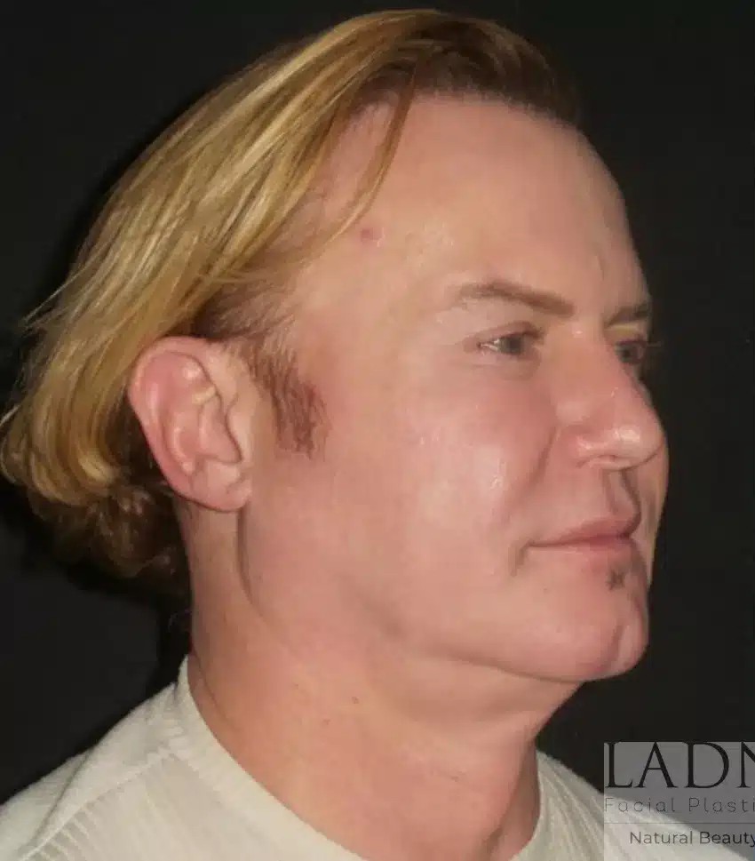Facial Plastic Surgery for Men before and after - before