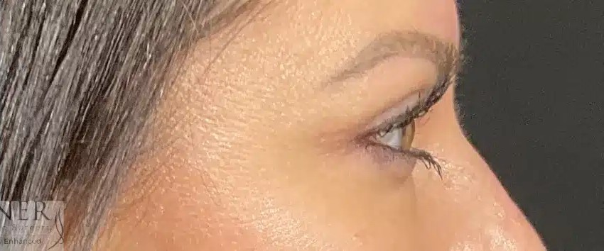 Upper Blepharoplasty before and after - after