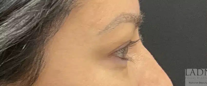 Upper Blepharoplasty before and after - before