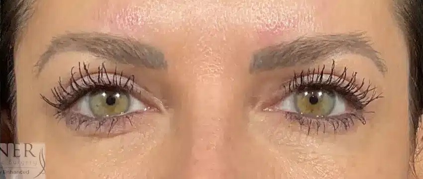 Upper Blepharoplasty before and after - after