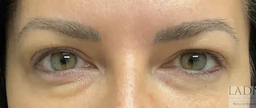 Upper Blepharoplasty before and after - before