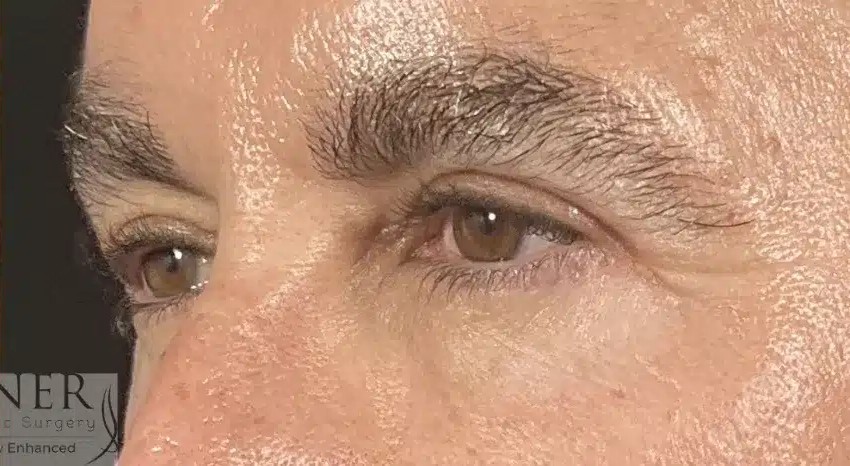 Upper and Lower Blepharoplasty & Facial Plastic Surgery before and after - after