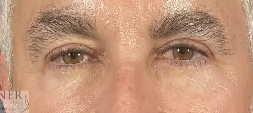 Upper and Lower Blepharoplasty & Facial Plastic Surgery before and after - after