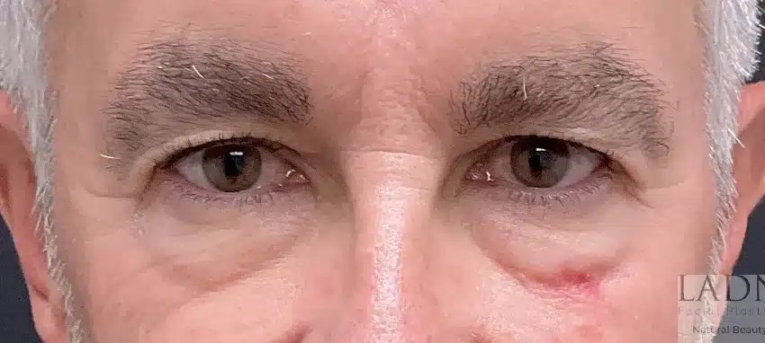 Upper and Lower Blepharoplasty & Facial Plastic Surgery before and after - before