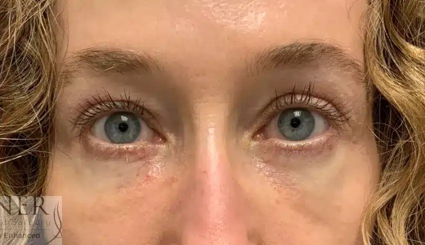 Upper and Lower Blepharoplasty before and after - after