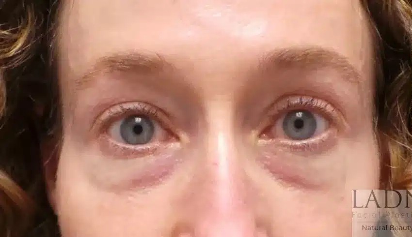 Upper and Lower Blepharoplasty before and after - before