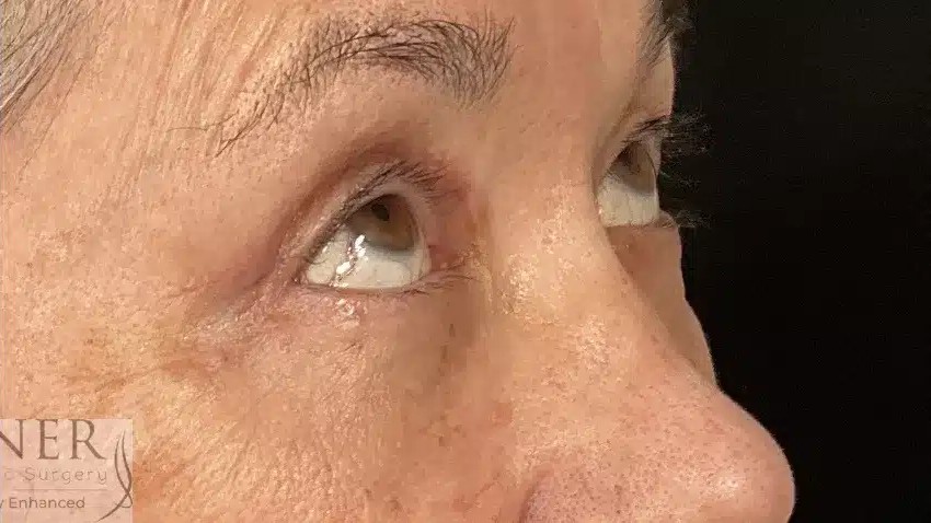 Upper and Lower Blepharoplasty before and after - after