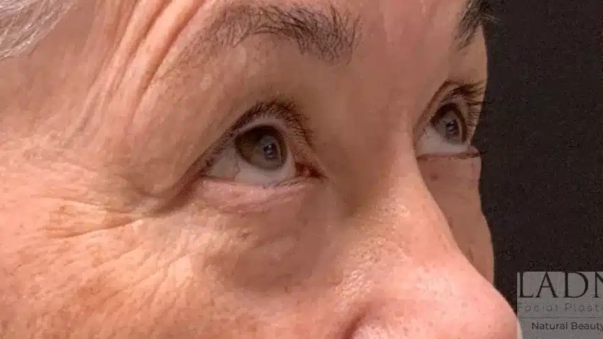 Upper and Lower Blepharoplasty before and after - before