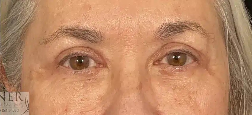 Upper and Lower Blepharoplasty before and after - after