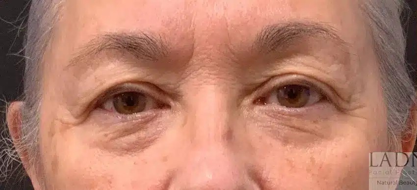 Upper and Lower Blepharoplasty before and after - before