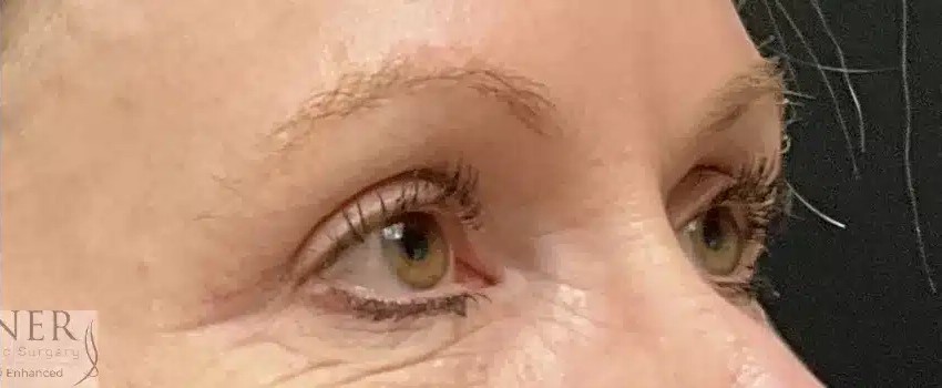 Upper Blepharoplasty before and after - after