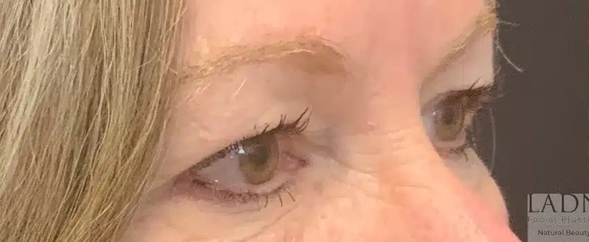 Upper Blepharoplasty before and after - before