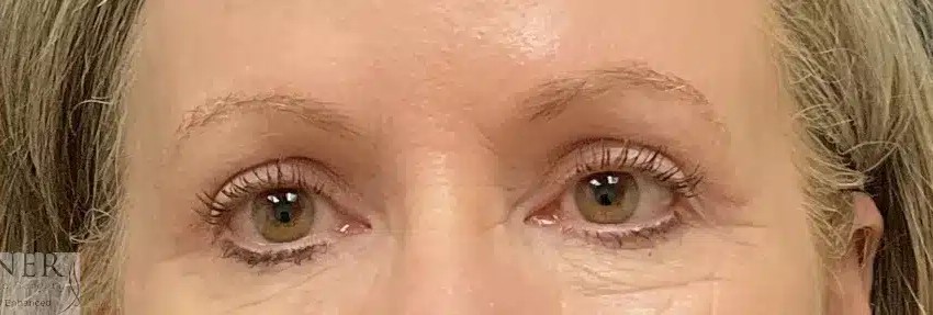 Upper Blepharoplasty before and after - after