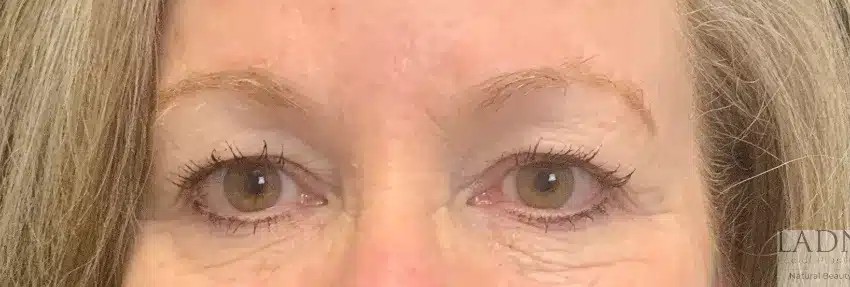 Upper Blepharoplasty before and after - before