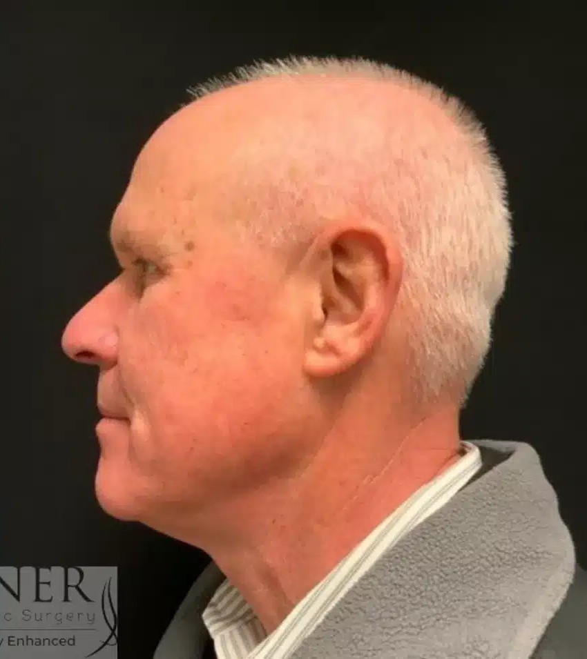 Upper Blepharoplasty & Facial Plastic Surgery before and after - after