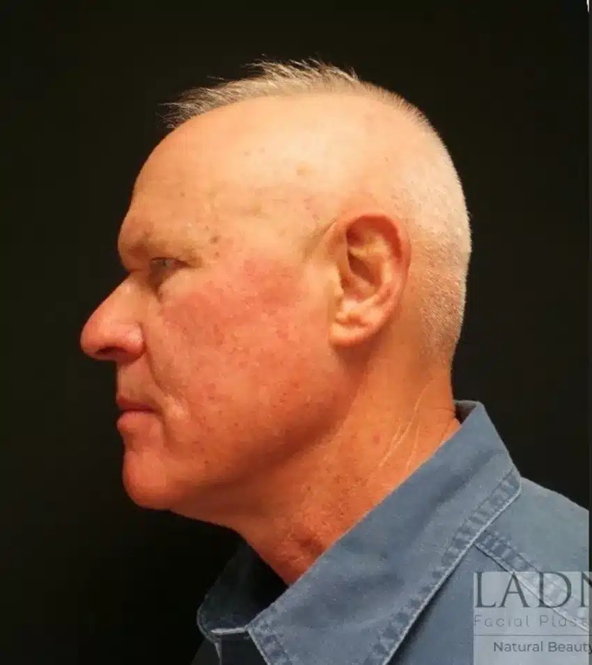 Upper Blepharoplasty & Facial Plastic Surgery before and after - before